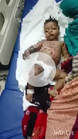 बहराइच: कोडवा में दो वर्षीय बालक पर गिरी खौलती चाय, झुलसने के बाद इलाज जारी