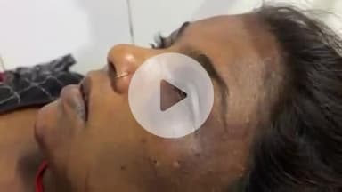 टीकमगढ़: जतारा में ससुराल पक्ष ने महिला को पीट-पीटकर किया घायल, आँखों में फेंकी सब्जी