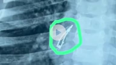 અમદાવાદ શહેર: 9 મહિનાનું બાળક LED બલ્બ ગળી જતા શ્વાસનળીમાં ફસાયો, અમદાવાદ સિવિલમાં બ્રોન્કોસ્કોપી કરી બહાર કઢાયો..