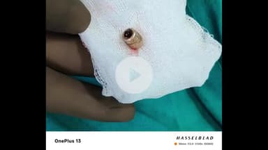 लाडपुरा: जिले में स्टूडेंट का सिर चीरकर गाल में फंसी गोली, घायल को नहीं पता कैसे लगी बुलेट