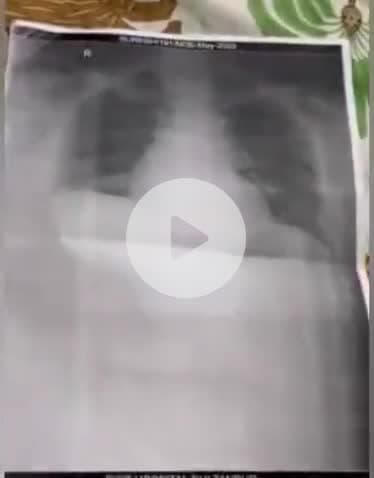 सुल्तानपुर: सुल्तानपुर मेडिकल कॉलेज का बुराहाल, संजय सिंह ने X पर शेयर की एक्स-रे फ़िल्म, लिखा- फर्जी भाषणों से दूर नहीं होगा