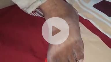 खालवा: खालवा में खेत पर काम कर रहे किसान को सांप ने काटा, जिला अस्पताल किया गया रेफर