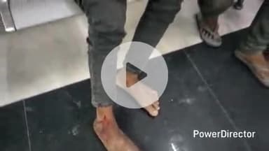 कटिहार: घोरदह में खेत जाते समय नाबालिग को जहरीले सांप ने डंसा, अस्पताल में भर्ती