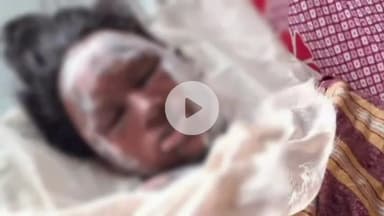 फरेंदा: गनेशपुर में पति ने पत्नी पर पेट्रोल डालकर लगाई थी आग, इलाज के दौरान पत्नी की हुई मौत