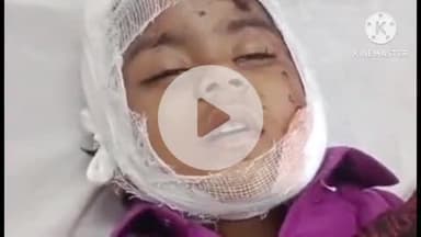 खरगौन: पागल कुत्ते ने नौ लोगों को काटा, डॉक्टर बोले- 4 साल की बच्ची के कान की सर्जरी करनी पड़ सकती है