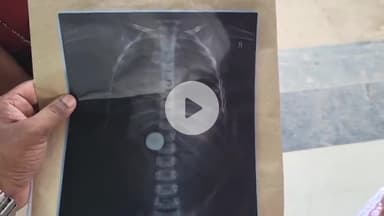 जहानाबाद: नदौल में खेलते समय बच्चे ने निगला सिक्का, सदर अस्पताल में भर्ती