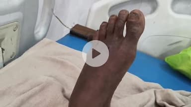 लोहरदगा: मुर्की तोड़ार मैना टोली में सांप काटने से एक व्यक्ति गंभीर, रिम्स रेफर