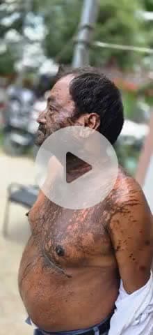 मौजे खजुरी निवासी मनोज कुमार को राम बढ़ई और सीधन कुशवाहा ने तेजाब से नहलाया और धमकी देते हुए ये भी कहा सिवान तेजाब कांड