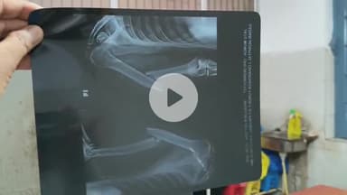 लोहरदगा: झखरा में खपरैल मकान की मरम्मत करते समय गिरने से मजदूर गंभीर, रिम्स रेफर