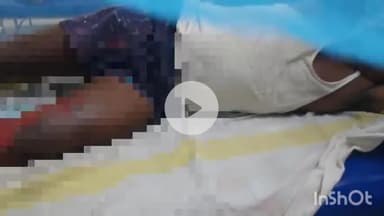 नवादा: फरहा गांव में सिलेंडर में आग लगने से एक युवक झुलसा, अस्पताल में कराया गया इलाज