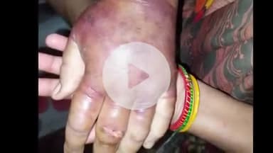 कोल: गांव नेहरा में वृद्ध व्यक्ति अनजान कीड़े का शिकार हुआ, निजी अस्पताल में उपचार के दौरान हुई मौत