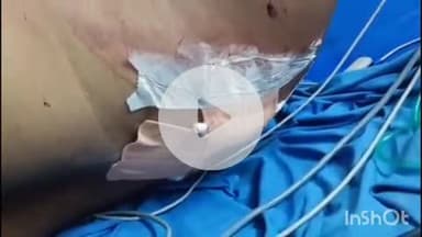 कहरा: सलखुआ थाना क्षेत्र में बालू गिट्टी व्यवसायी को बदमाशों ने गोली मारी, सहरसा के अस्पताल में भर्ती