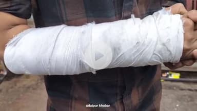 बड़गांव: हाथीपोल थाना क्षेत्र में पुलिस की दबिश पर बर्बरता का आरोप, युवक का हाथ टूटा, परिजनों ने एसपी से की शिकायत