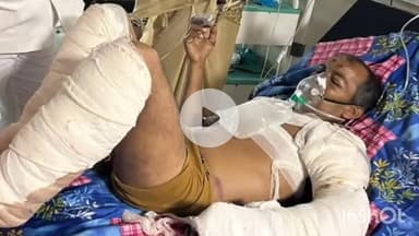 त्योंथर: ककरहा निवासी देवराज विश्वकर्मा बिजली विभाग की लापरवाही से 11000KV करंट लगने से घायल, इलाज जारी