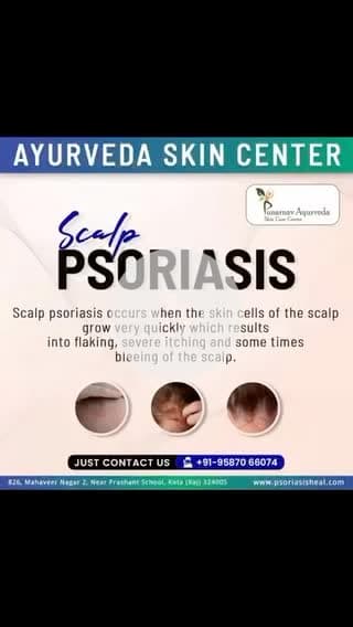 Ayurveda skin hospital kota 
Call 9587066074