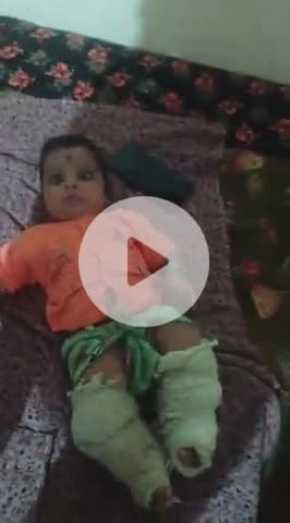 इस बच्चे के जन्म से ही क्लब फुट यानी पैरों का टेडा होना एक बीमारी है यह बच्चा ग्राम बंथली में उमेश पुत्र गणपत बैरवा ह जो
