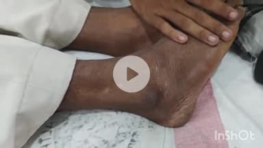 घैलाढ़: रतनपुरा गांव में खेत में यूरिया डालते समय राम बहादुर यादव को जहरीले सांप ने काटा, हुए बेहोश