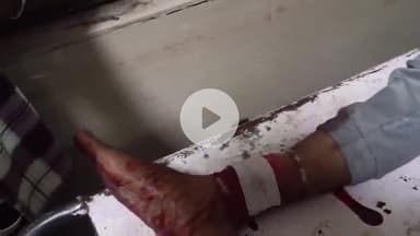 लाडपुरा: कोटा के रेलवे कॉलोनी थाना क्षेत्र में एक युवक पर पाइप से जानलेवा हमला, युवक का पैर टूटा, अस्पताल में उपचार जारी