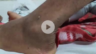 लोहरदगा: चरिमा गांव: सांप ने युवक को दो बार काटा, घबराकर गिरा, परिजन सदर अस्पताल ले गए