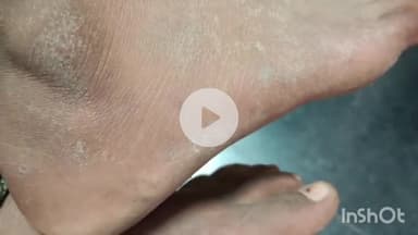 मुंगेर: लक्ष्मणपुर में किशोरी को सांप ने डसा, हालत बिगड़ने पर सदर अस्पताल में भर्ती