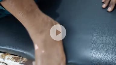 लोहरदगा: ज़हरीले सांप के काटने से महिला गंभीर, ज़िला अस्पताल में भर्ती