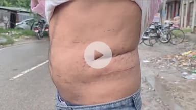 पडरौना: कुशीनगर में इलाज के बहाने किसान की किडनी निकालकर बेचने का आरोप, अस्पताल संचालक पर केस दर्ज, CMO रिपोर्ट पर होगी कार्रवाई