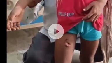 बरेली: सुभाष नगर क्षेत्र में 6 वर्षीय बच्चे को आवारा कुत्तों के झुंड ने घेरा, जिला अस्पताल में हुआ उपचार