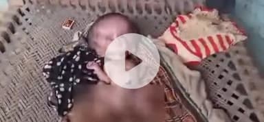 कर्वी: मऊ पूरब पताई में जन्मी विकृत शारीरिक बनावट की बच्ची