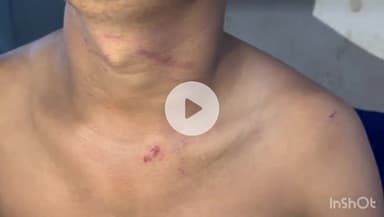 नवादा: मरुई गांव में युवक के साथ की गई मारपीट, सदर अस्पताल नवादा में कराया गया इलाज, बदमाशों ने किया था पिटाई