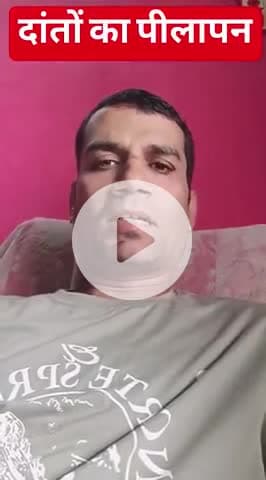 दांतों का पीलापन 
 #yellowteethchallenge 
 #yellowteeth #yellowteethsolution #YellowTeethNoMore #teethcleaning #teeth