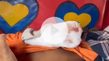 झांसी: अंबाबाय प्रीतमपुर में ठेकेदार और मकान मालिक की लापरवाही से मजदूर करंट लगने से झुलसा, हाथ काटना पड़ा