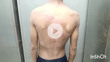 आरा: जवाहिर टोला महुल्ला में टेम्पू के बैट्री चार्जर की चोरी के आरोप में जमकर की गई पिटाई, घायल युवक को अस्पताल में कराया गया