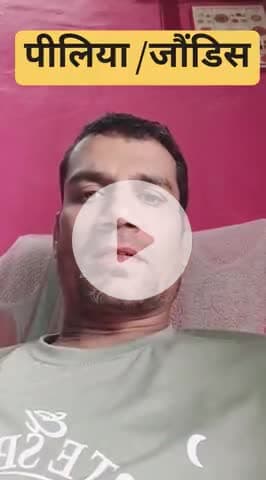 पीलिया /जौंडिस
 #pelia
 #Bilirubin #highbilirubin #liverhealth #LiverCirrhosis #LiverCare #bilirubinhigh 
@पीलिया