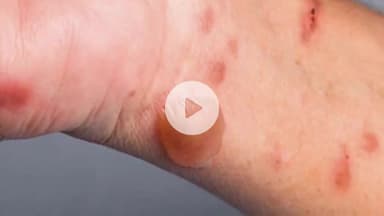 खंडवा नगर: खंडवा में बच्चों पर टोमेटो फ्लू का कहर, एक्सपर्ट ने बताए बचाव के उपाय