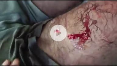 लाडपुरा: कोटा के गांधी कॉलोनी में चाकू से हमला, जेके लोन अस्पताल का संविदाकर्मी गंभीर रूप से घायल, अस्पताल में भर्ती उपचार जारी