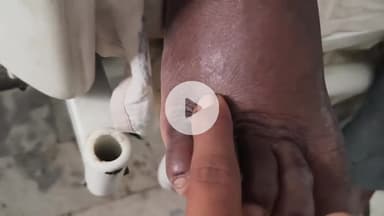 लोहरदगा: लोहरदगा ज़िले में सांप काटने से दो लोग गंभीर, जागरूकता अभियान की आवश्यकता