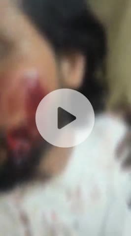 कानपुर: पनकी में गे साढ़ू ने अनैतिक संबंध बनाने का दबाव डाला, मना करने पर नाक काटकर किया जानलेवा हमला