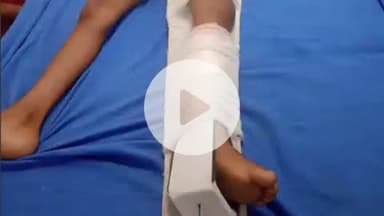 करनैलगंज: अशोकपुर स्कूल में कबड्डी खेलते समय 5 वर्षीय छात्र घायल, पैर टूटा