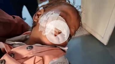 मुरादाबाद: मुंडापांडे थाना क्षेत्र में घर के बाहर खेल रहे बच्चे पर 6 से 7 बंदरों ने हमला कर किया घायल