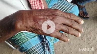 सासाराम: सासाराम के सुकिही गांव में सांप काटने से एक व्यक्ति की तबीयत बिगड़ी