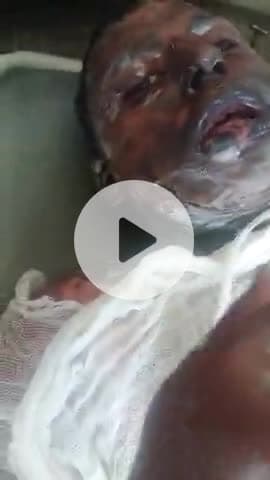 jale ladke ne apne muh se bayan diye baba ke khilafh jise use jalaya tha