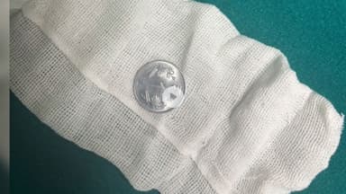 ગાંધીનગર: ENT દ્વારા સિવિલ હોસ્પિટલમાં બે બાળકોના અન્નનળીમાં ફસાયેલા સિક્કો બહાર કાઢવામાં આવ્યો