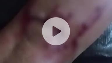 फतेहाबाद: शमशाबाद के ग्राम बड़ा गांव में आवारा कुत्तों का आतंक, 7 लोगों को बनाया शिकार, सीएचसी में किया गया उपचार