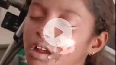 प्रतापगढ़: उसीपुर गांव में पटाखे से झुलसी किशोरी का सीएचसी में चल रहा इलाज