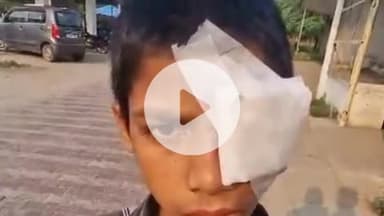 झांसी: बाबरी गांव में छठवीं कक्षा के छात्र की आंख में फूटा पटाखा, आंख हुई डैमेज, ग्वालियर किया रेफर