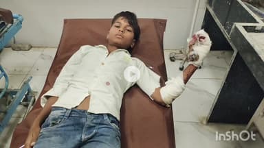 भीलवाड़ा: लसाडिया में पटाखे पर स्टील की ग्लास रखकर फोड़ते वक्त पटाखा फटने से किशोर गंभीर घायल हुआ