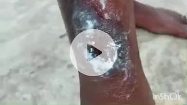 नानपारा: नवाबगंज में रॉकेट से झुलसी महिला, शिकायत पर दबंगों ने की मारपीट, पुलिस जांच में दी तहरीर