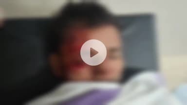 उदवंत नगर: ससुराल जाते समय हादसा: जमुआव में नहर किनारे गिट्टी पर फिसली बाइक, दो युवक गंभीर रूप से घायल, अस्पताल में भर्ती