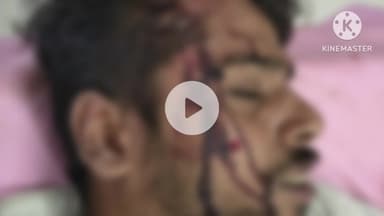 आगर: ग्राम ढाबली में डीपी तार विवाद में काका ने भतीजे पर कुल्हाड़ी से किया हमला, सिर और पैर में आई गंभीर चोट