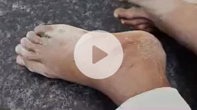 खड्डा: देवीपुर में भैंस चरा रहे किशोर को जहरीले गोहटी ने डसा, कुशीनगर जिला अस्पताल में भर्ती, उपचार जारी